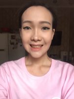 3months later jawsurgery (2).jpg