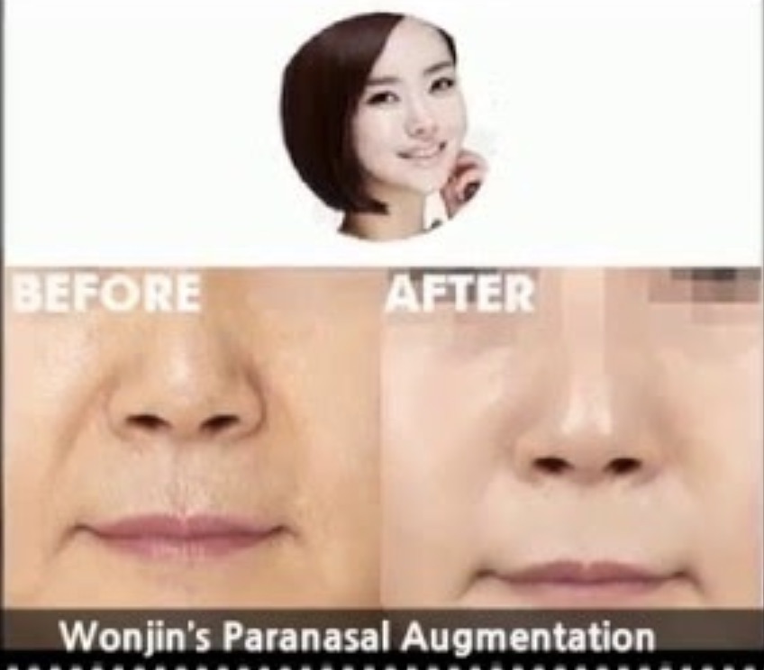 Wonjin Seoul paranasal implants customised.jpg
