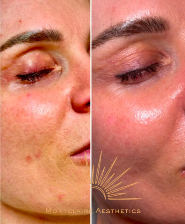 biospicule-microneedling-barnes-london.png
